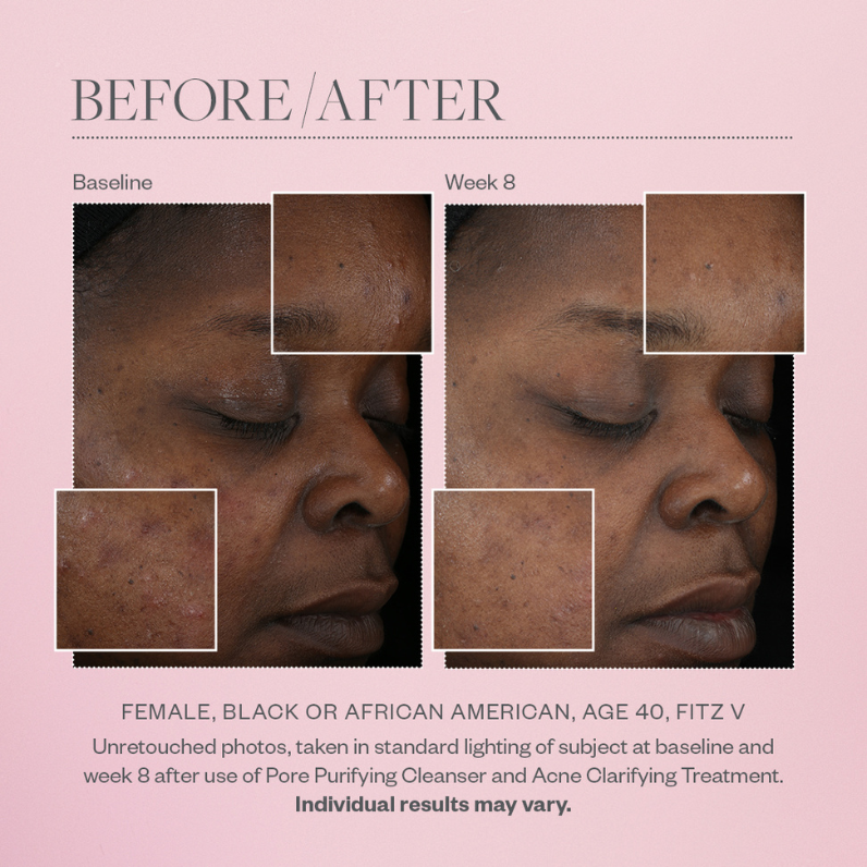 SkinMedica Acne Clarifying Treatment